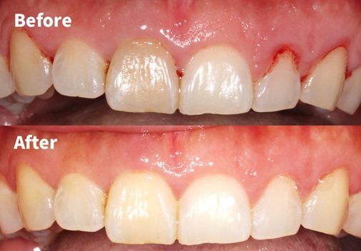 Before and After Whitening + PDRN Gum Rejuvenation