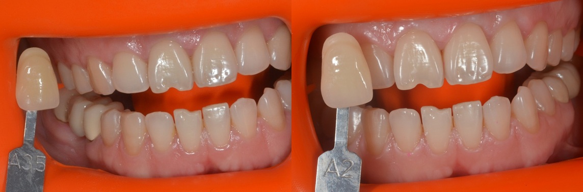 Example of teeth whitening results for grayish natural teeth - Yonsei Famille Dental Clinic