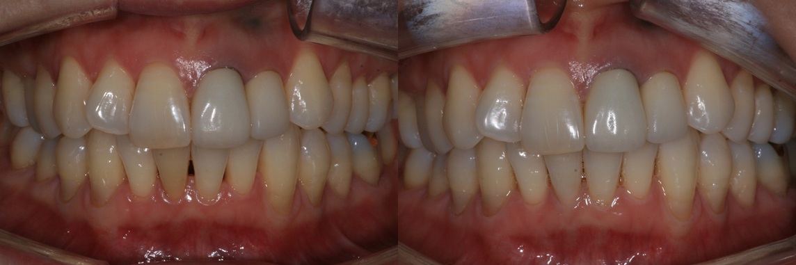 Zirconia crown for a tooth discolored after root canal treatment