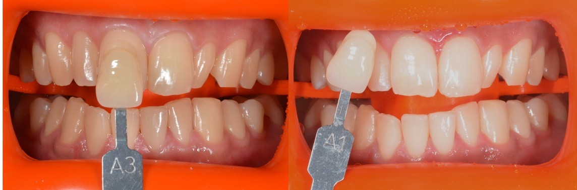 Example of teeth whitening results for yellowish natural teeth - Yonsei Famille Dental Clinic