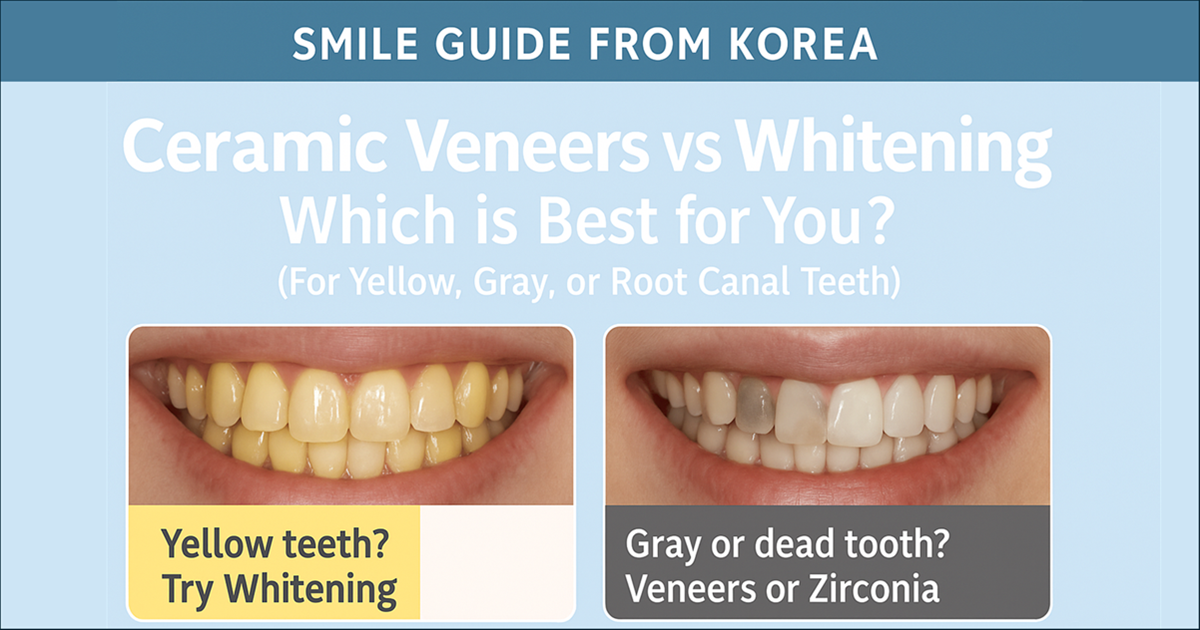 Ceramic Veneers vs Whitening