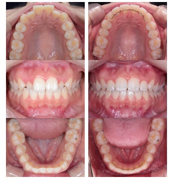 マジックアライン症例写真 Before After
