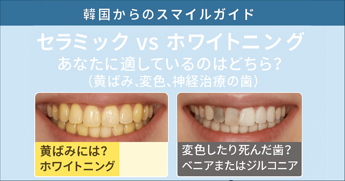 ホワイトニング vs ベニア 比較記事
