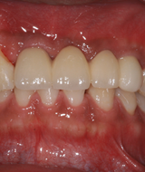 상악 전치 수복 | 네비게이션 임플란트