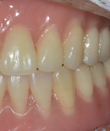 전체 발치 후 수복 | 임플란트 틀니