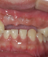 상악 전치 수복 | 네비게이션 임플란트